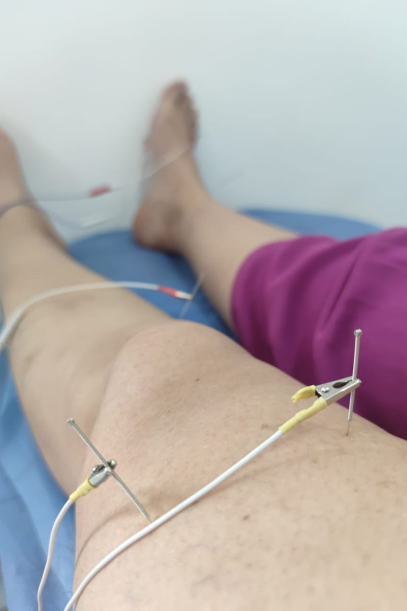 Apoyos_Electroacupuntura_01