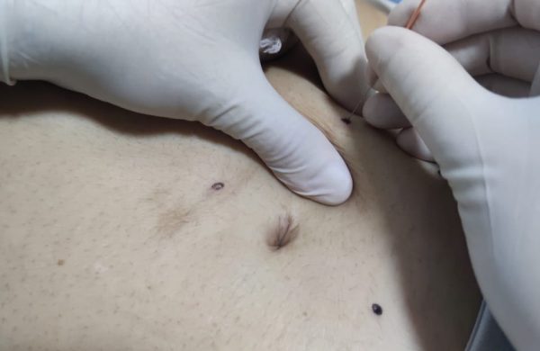 Procedimientos_Acutomo_06