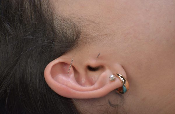 Procedimientos_Auriculoterapia_01