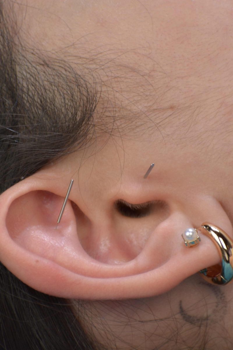 Procedimientos_Auriculoterapia_01